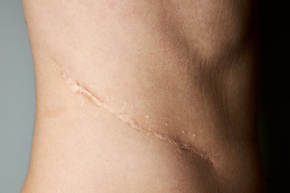 Why Can Scar Removal Treatments Cause Redness?