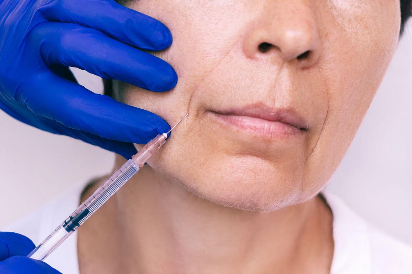 Do Volift Fillers Work Well for the Smile Lines?