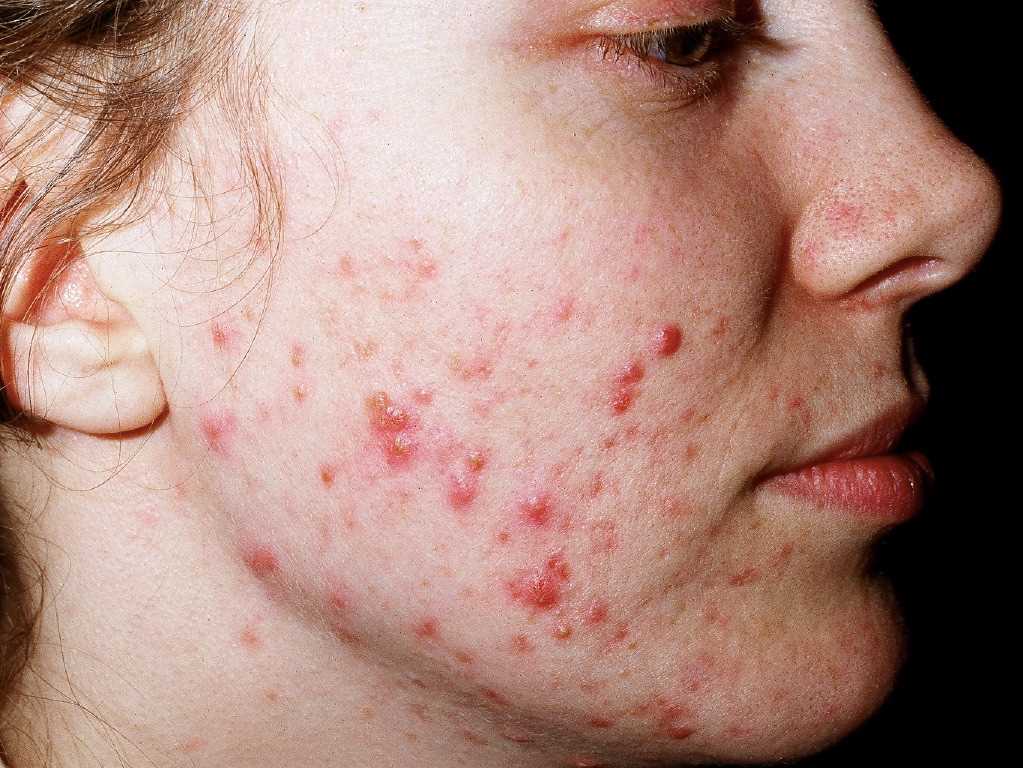 Does Acne Treatment in Abu Dhabi Work on Hormonal Acne