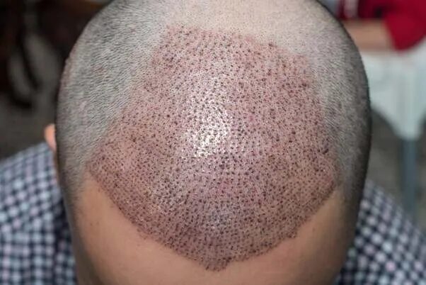 Does Hair Transplant Improve Hairline Shapes?