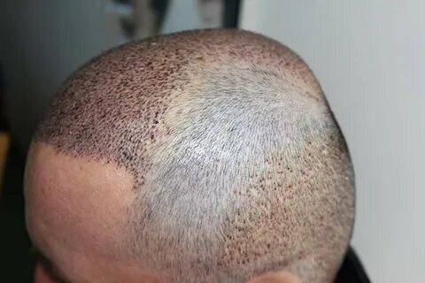 Does Hair Transplant Improve your Hairline Shape?