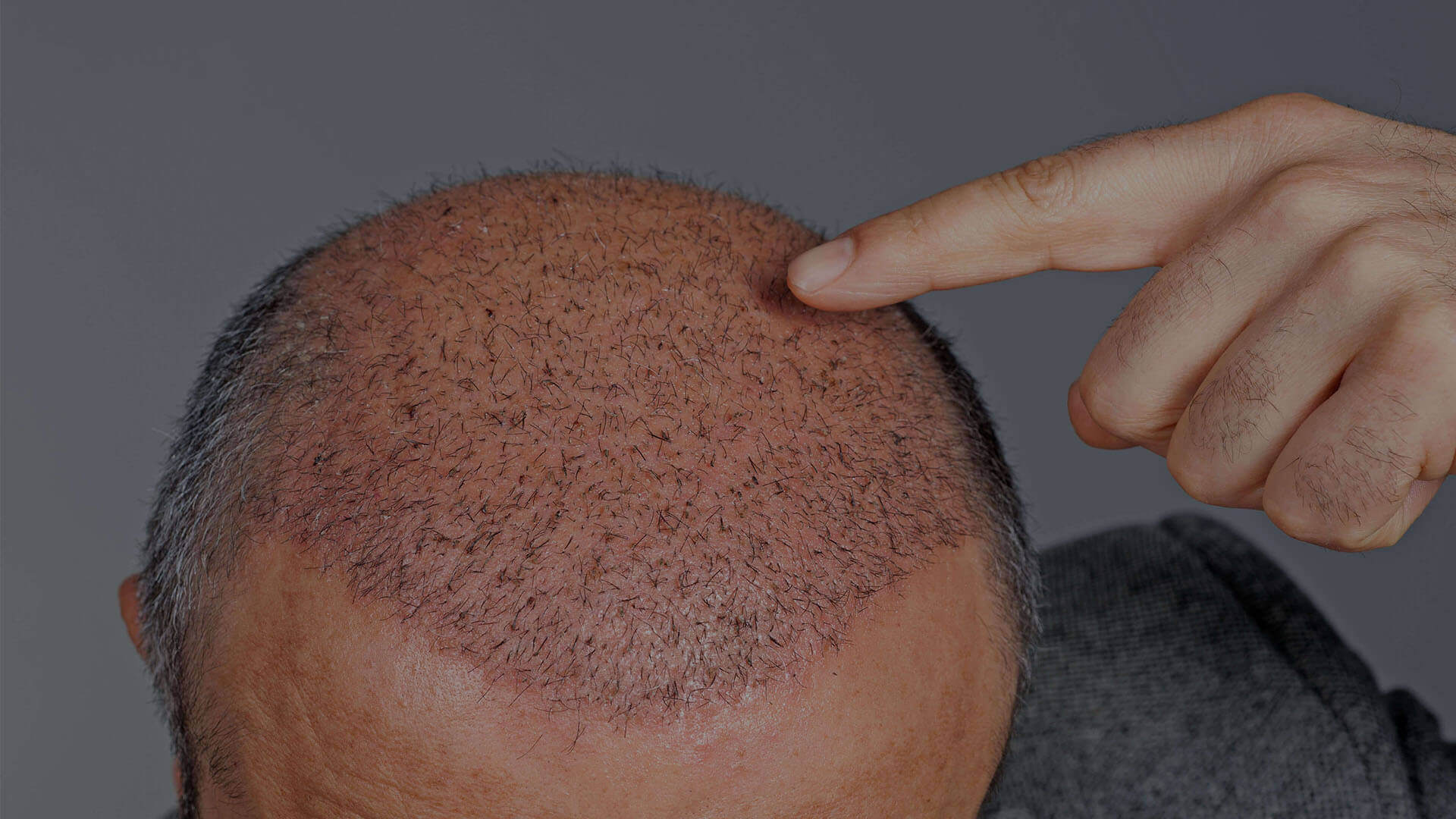 Does Hair Transplant Improve Your Hairline Shape?