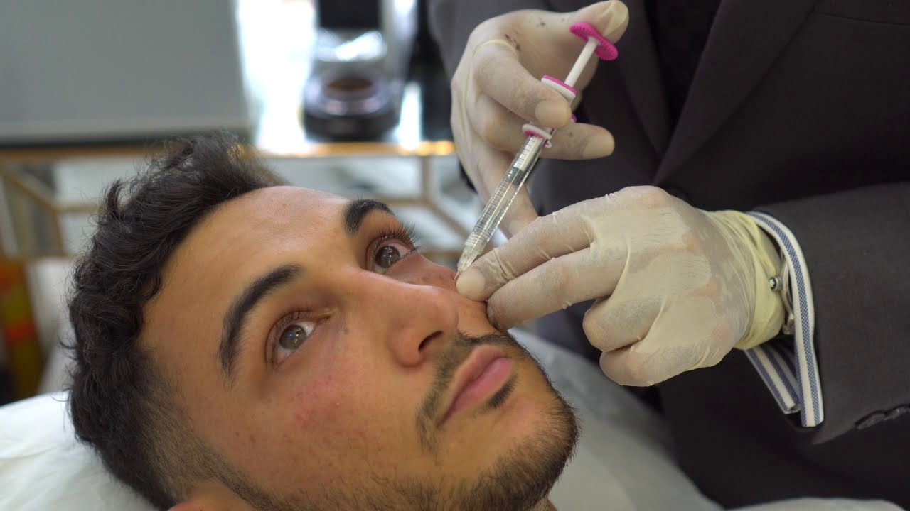 Does Under-Eye Filler Treatment Hide Under Eye Bags?