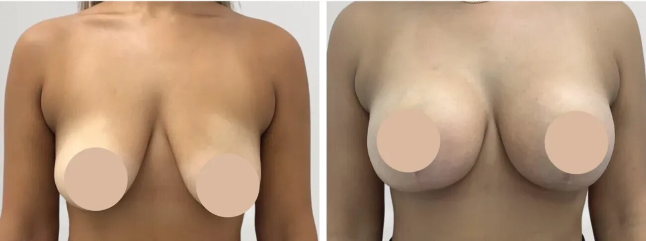 Skilled Best Breast Reduction Surgeons in dubai for Posture Improvement