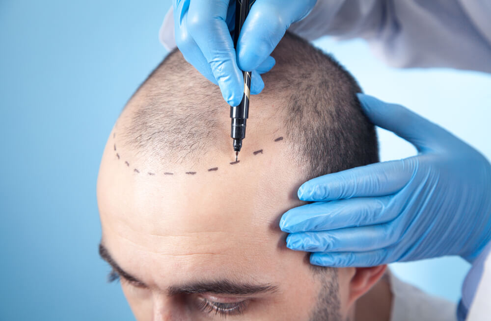 Finding the Right Specialist for Hair Transplant in Dubai