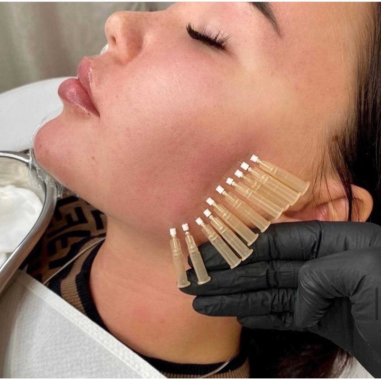 How Do PDO Mono Threads Enhance Facial Features Naturally?