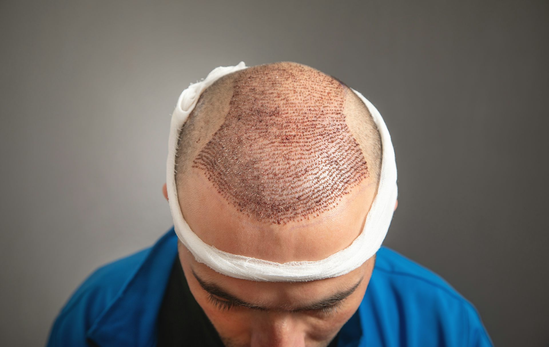 How Does Hair Transplant Handle Advanced Hair Loss Stages?