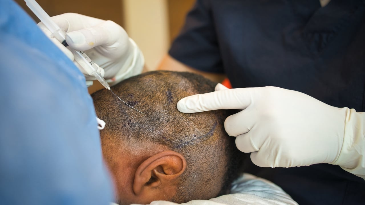 How Does Hair Transplant for Men Treat Bald Patches Effectively?