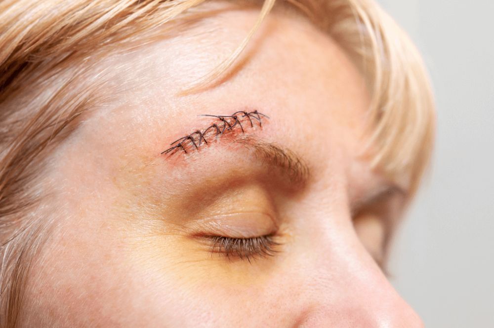 Why Can Scar Removal Treatments Cause Redness?