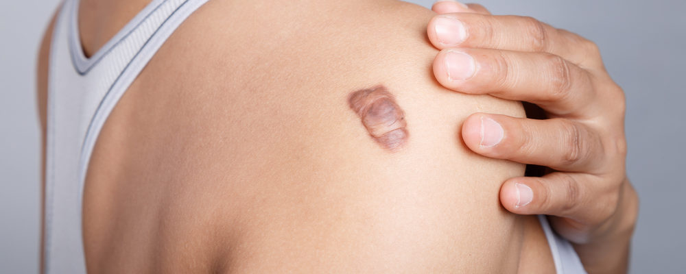 How Effective Is Keloid Treatment for Smoother Scars?