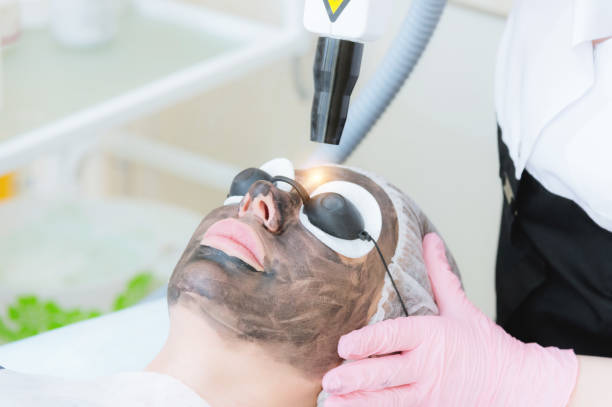 How Laser Carbon Peel Supports Younger Looking Skin Naturally