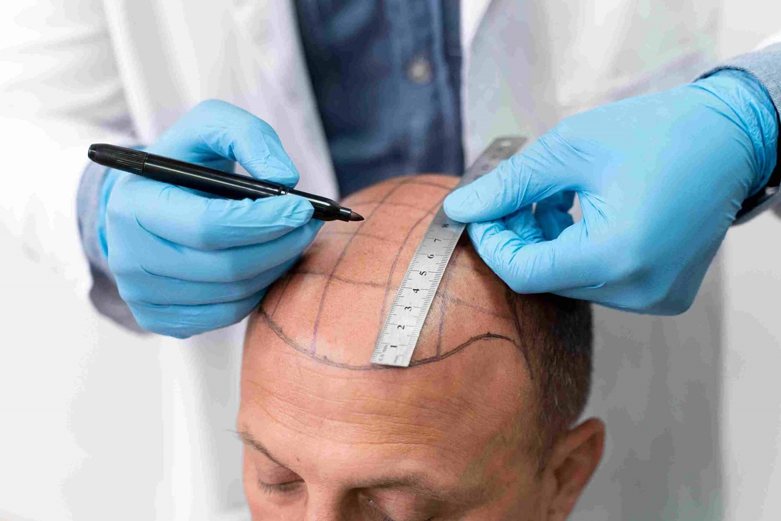 How Scalp Micropigmentation in Abu Dhabi Looks Natural