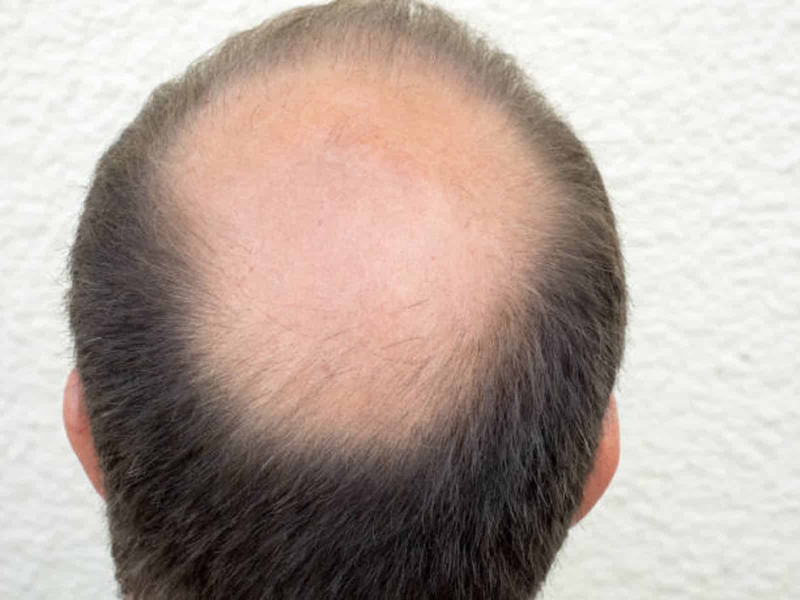 Is Crown Hair Transplant Suitable for Thin Scalp Areas?