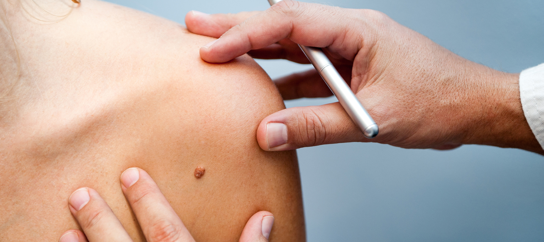 Does Mole Removal Work on Raised and Flat Moles?