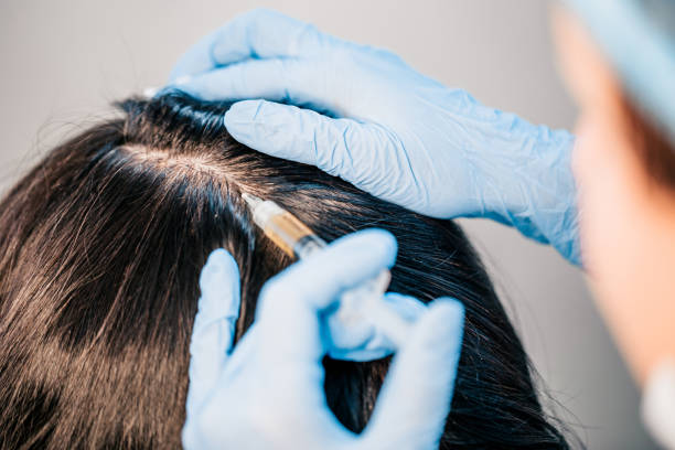 Is PRP treatment a Smart Choice for Hair Loss Treatments