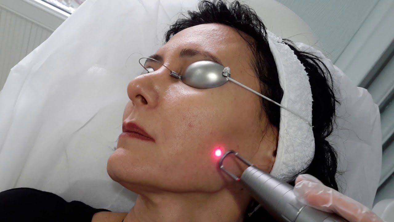 Is Pico Laser Treatment Effective for Hormonal Pigmentation?