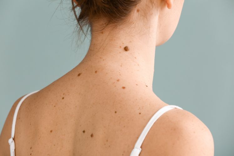 Is Skin Tag Removal in Abu Dhabi Safe for All Skin Types