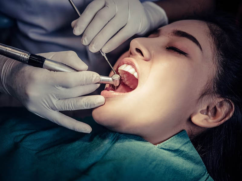 What Causes the Need for Root Canal Treatment?