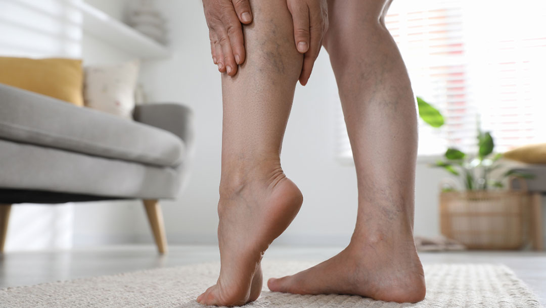 Understanding Spider Veins in Manchester: Effective Removal for Smooth, Clear Skin