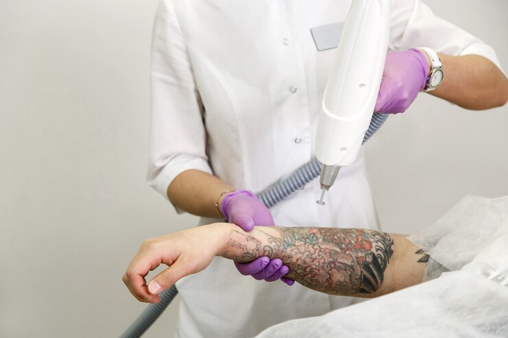 Tattoo Removal for Sensitive Skin: A Complete Guide