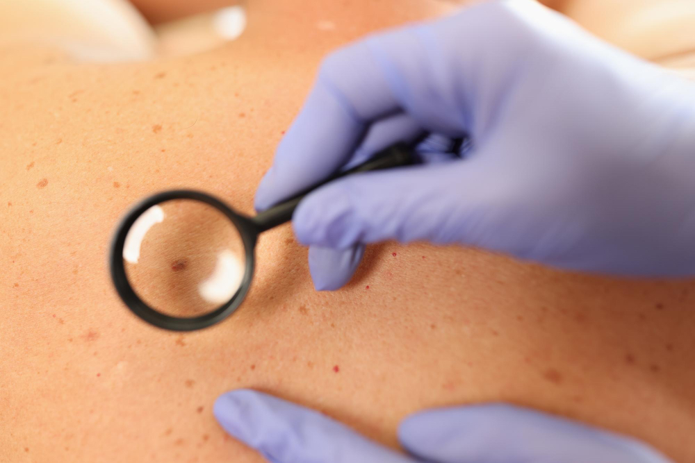 Warts Removal Treatments: Easy Solutions Explained