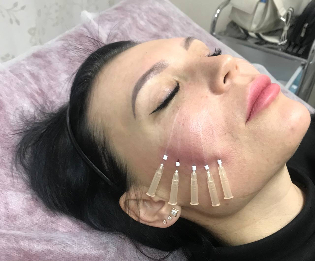 What Areas Can PDO Mono Threads Treat Effectively?