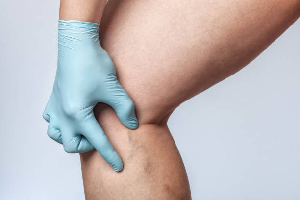 What Causes the Need for Spider Vein Treatment