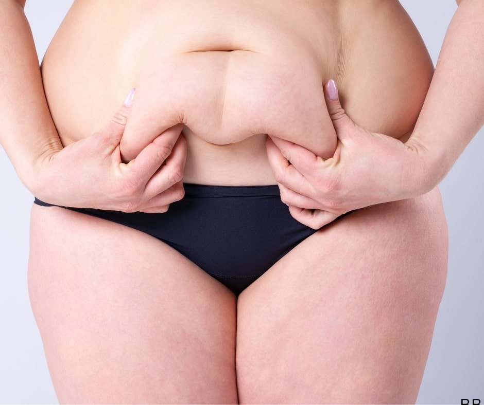 What CoolSculpting Fat Freezing in Abu Dhabi Treats Best