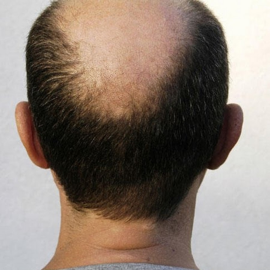 What Improves Sparse Crown Coverage After Crown Hair Transplant?