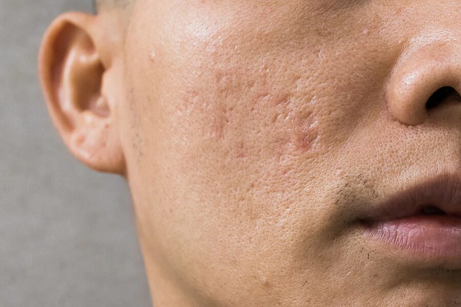 What Laser Acne Scar Treatment Results to Expect