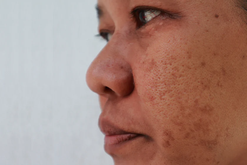 What Skin Concern Can Melasma Treatment Treat?