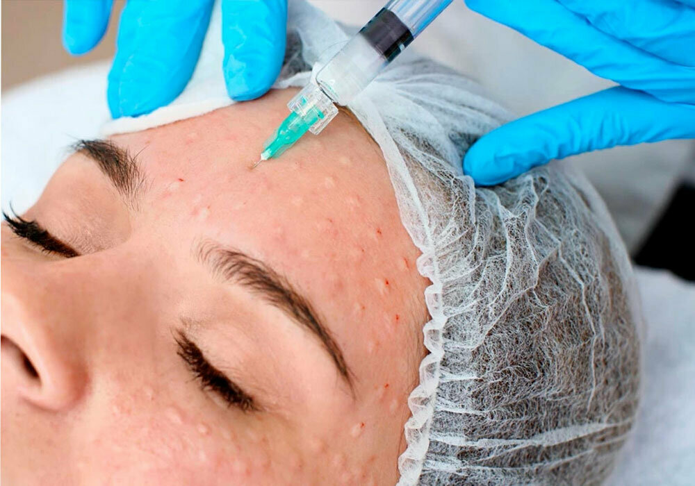 Vampire Facial in Dubai