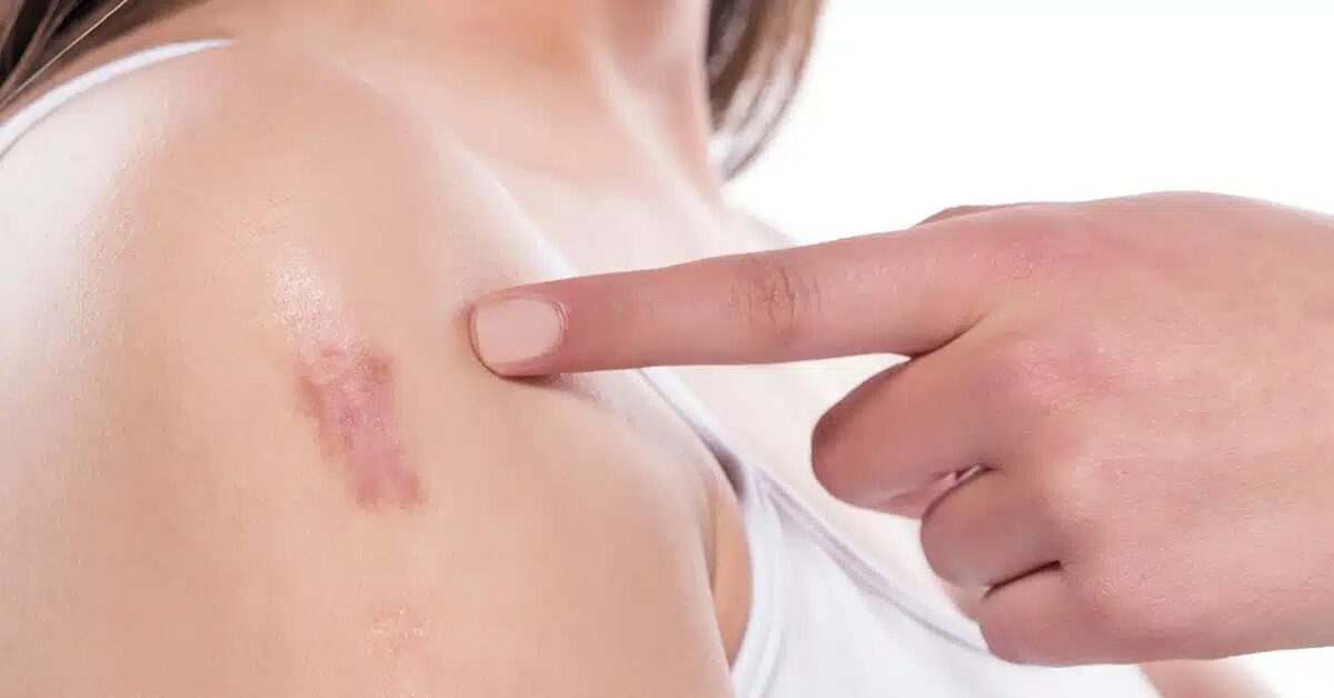 What Triggers Keloid Scars Formation on Skin?