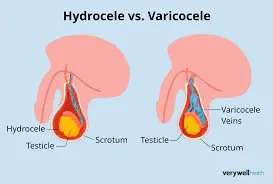 Can Varicocele Go Away Without Surgery? Truth, Myths & Real Solutions