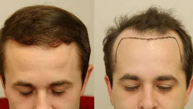 Best Hair Transplant in Dubai: Top Clinics, Costs & Results Explained