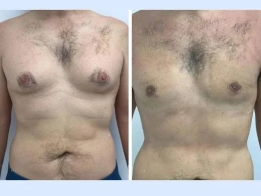 Best gynecomastia surgeons in Dubai:body contouring and confidence restoration