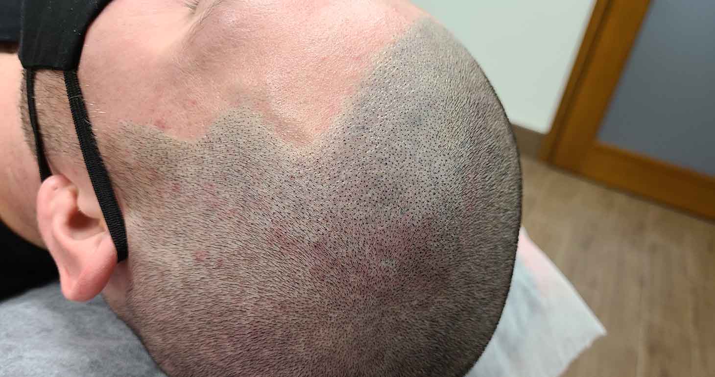 ما يجب معرفته قبل التصبغ المجهري لفروة الرأس؟