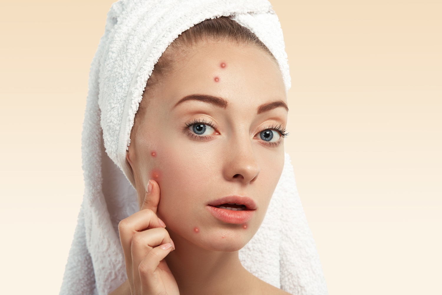 Why Acne Scar Treatment Costs Vary So Much | Aarna Clinic