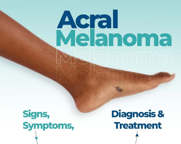 What is Acral Lentiginous Melanoma? Signs & Symptoms