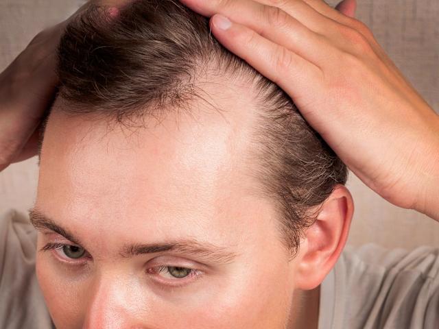 Can Hair Transplant Restore Density in Bald Areas?