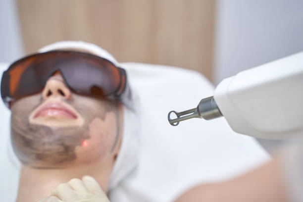 Can Laser Carbon Peel in Abu Dhabi Boost Skin Confidence?