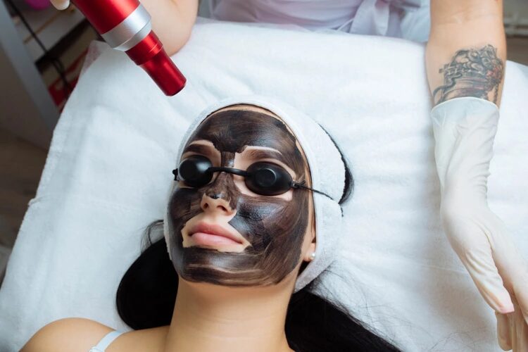 Can Laser Carbon Peel reduce fine lines and wrinkles?