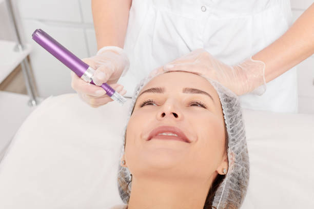 Can Microneedling Help With Early Aging Signs?