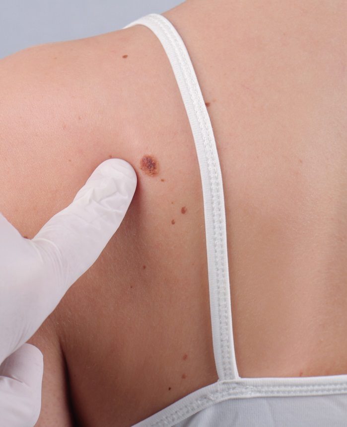 Can Skin Tag Removal Be Done on Sensitive Skin Safely?