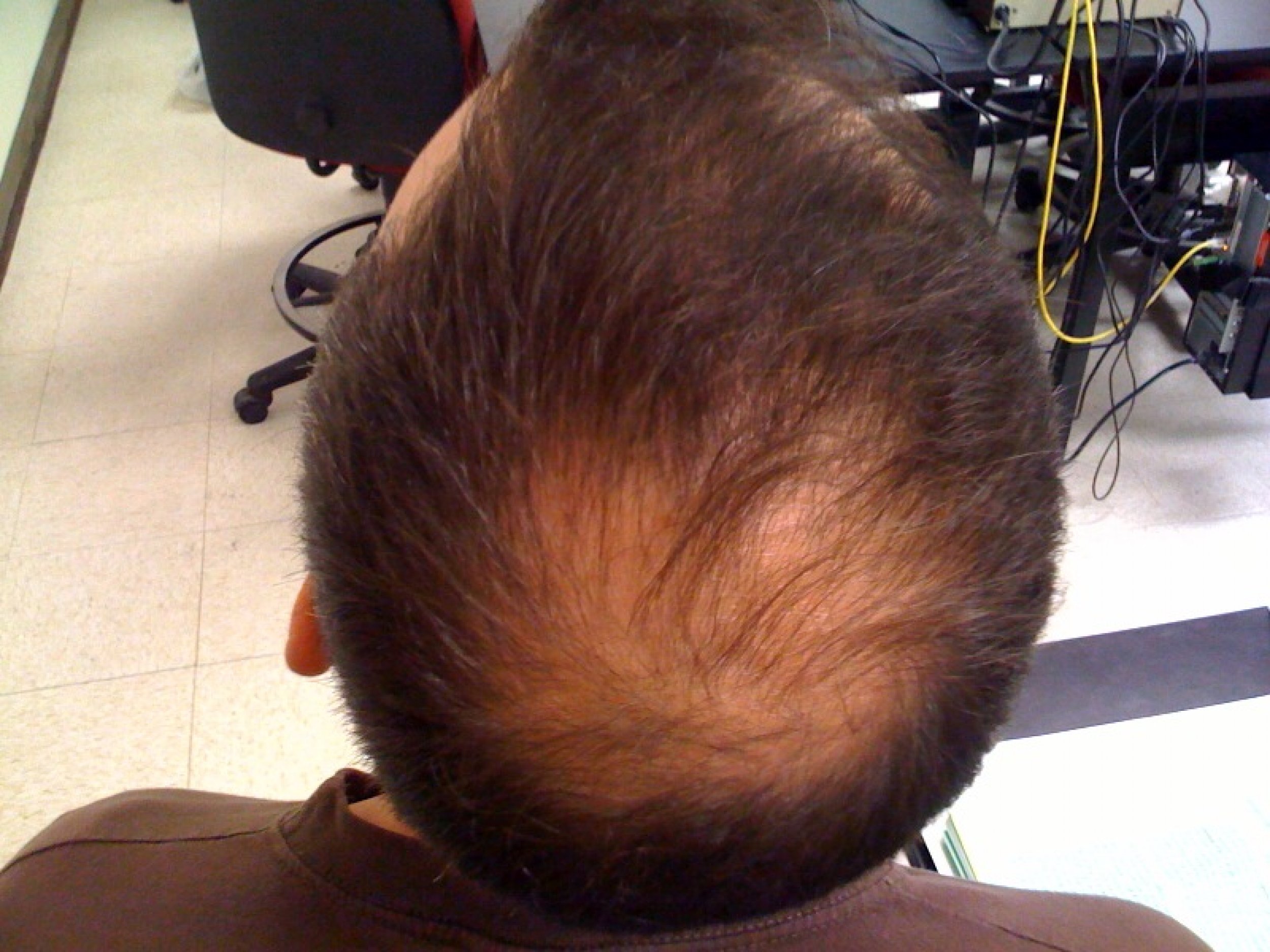 Can crown hair transplant restore thinning crown areas?