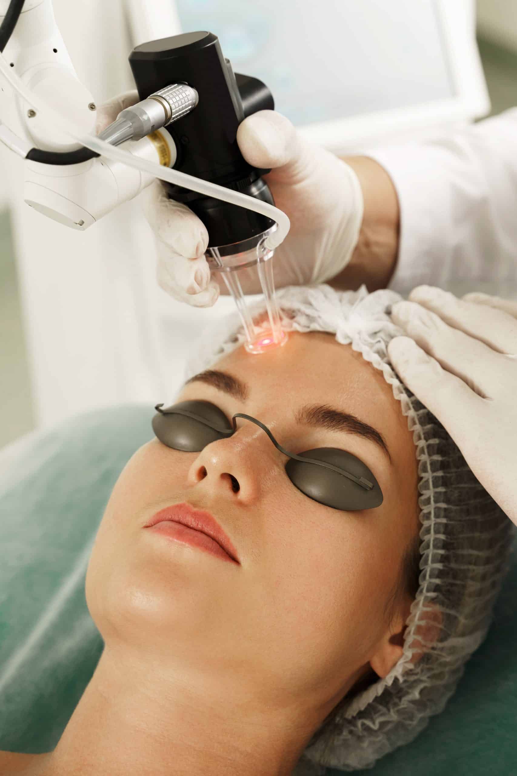 Discover Younger Looking Skin with Fractional CO2 Laser