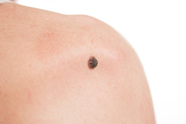 Does Skin Tag Removal Work Better Than Natural Treatments