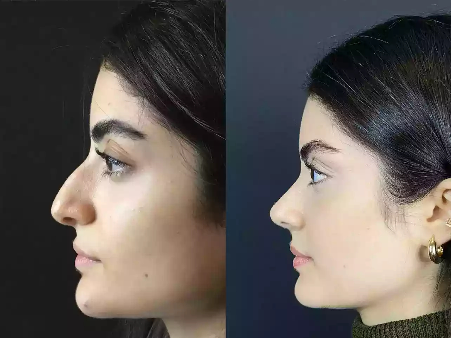 Nose Surgery in Dubai: Key Questions to Ask Your Doctor