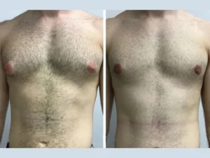 Best Doctors in Dubai for gynecomastia: A Step-by-Step Treatment Overview