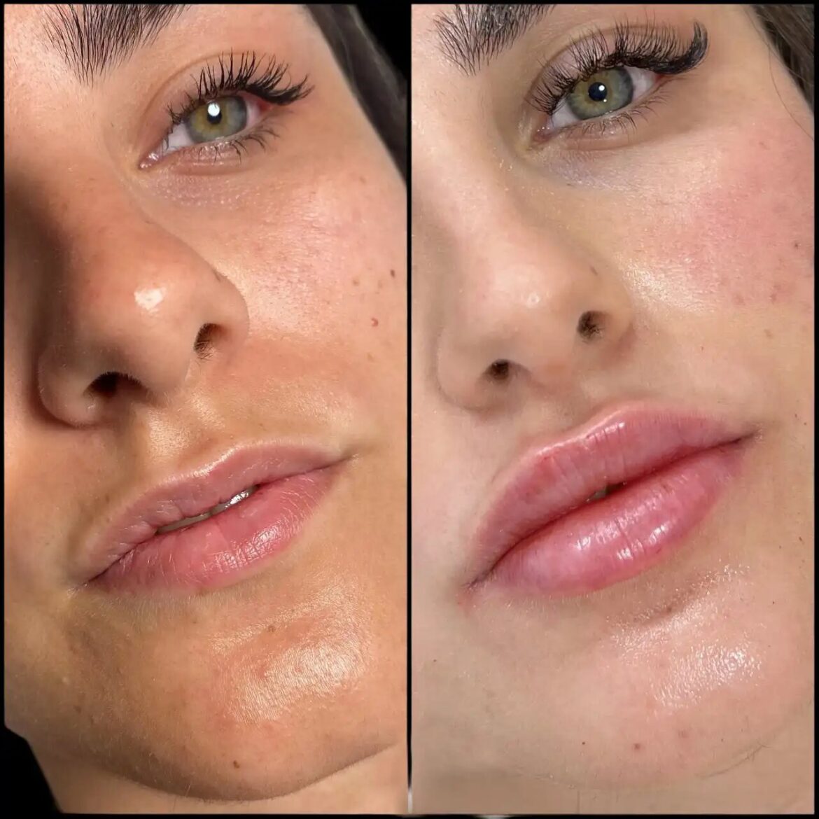 The Secret to Youthful Skin: Fillers Treatment in Dubai